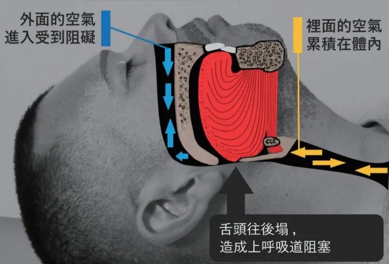 通过这样训练就能改善睡觉打呼噜（转给需要的...）